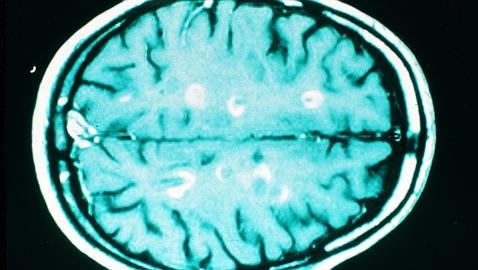 La primera pastilla contra la esclerosis múltiple