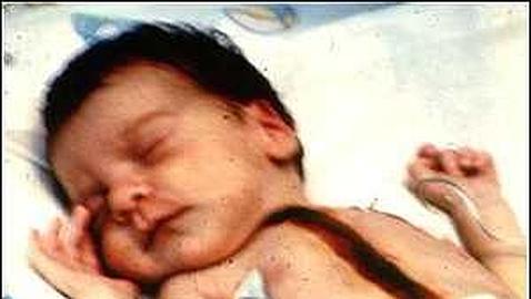 El fallido experimento con «Baby Fae», la niña que vivió 21 días con el corazón de un mono