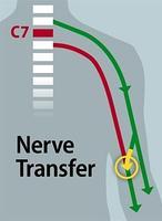 Un «bypass» devuelve la movilidad de las dos manos a un tetrapléjico