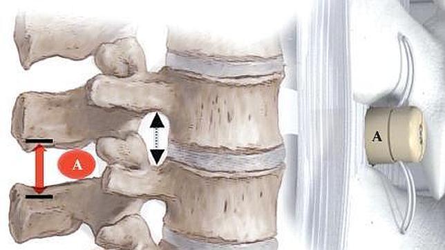 ¿Qué es una estenosis del canal lumbar?