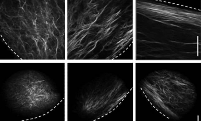 Cómo se propaga el cáncer de mama
