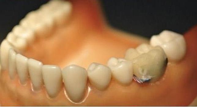 Un sensor dental para alertar si comes o fumas demasiado