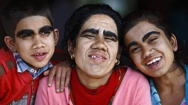 Toda una familia supera con éxito el «síndrome del hombre lobo»