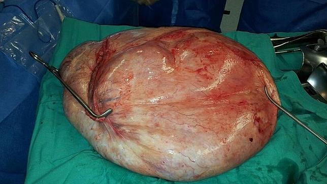 La mujer a la que extirparon un tumor de 25 kilos: «Me he asustado al ver la foto»