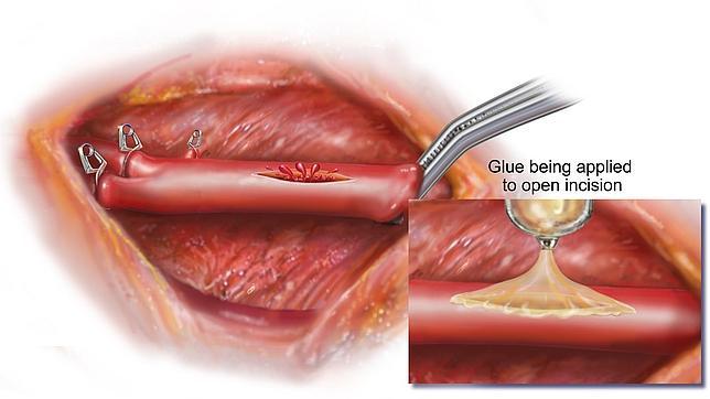 Un pegamento luminoso que repara los corazones