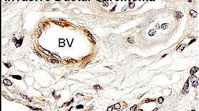 Poner freno a la metástasis del cáncer