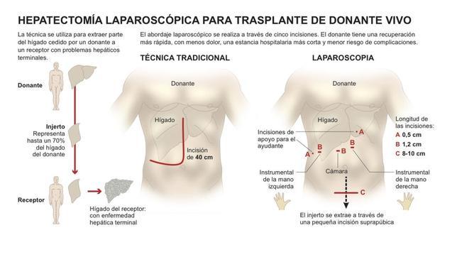 Extraen, por primera vez en España ,una porción de hígado de donante vivo por laparoscopia