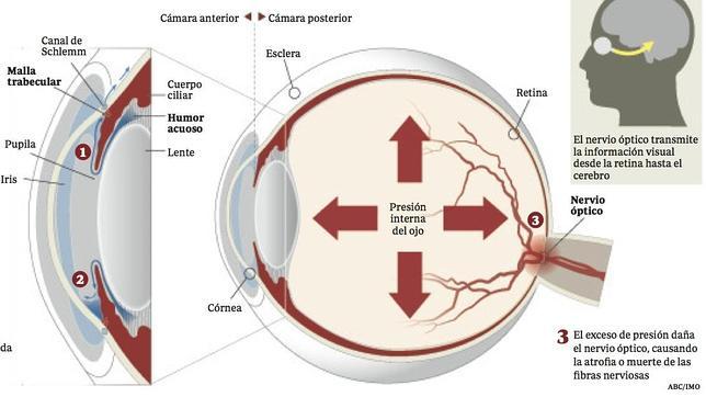 Glaucoma: el ladrón silencioso de la visión