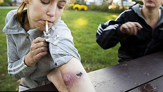 Una joven muestra los efectos del consumo de krokodil