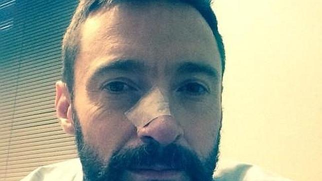 Intervienen a Hugh Jackman por otro carcinoma en la nariz