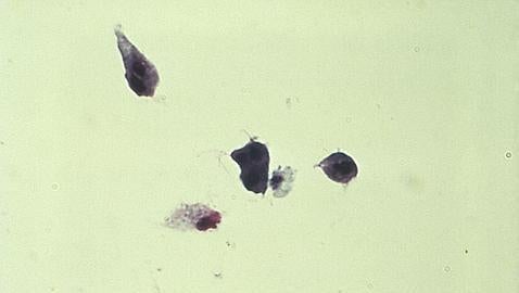 ¿Es el cáncer de próstata una infección de transmisión sexual?