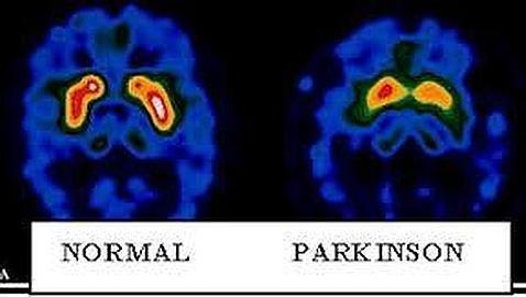 Espaldarazo al uso del trasplante neuronal para tratar el párkinson