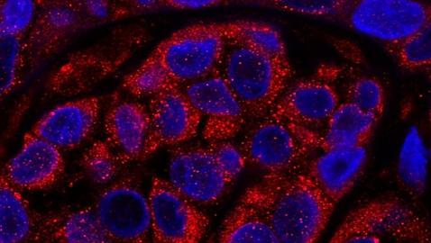 Hallan 40 genes que determinan la malignidad del melanoma