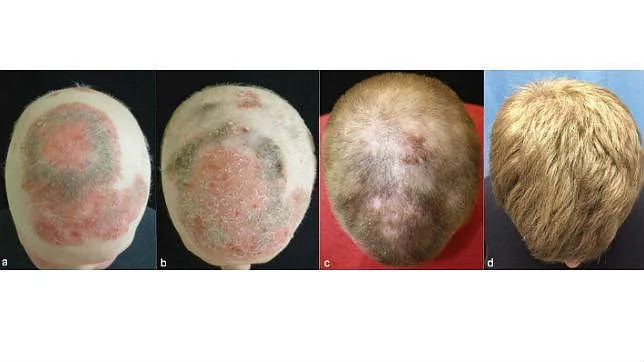 Un medicamento para la artritis pone fin a la alopecia