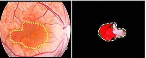 La combinación de células iPS y terapia génica podría curar la retinosis pigmentaria