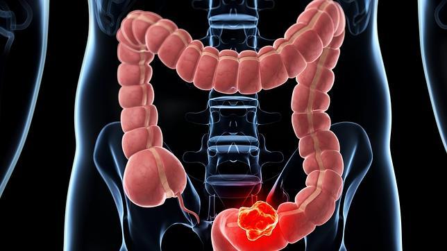 Las personas con déficit de calcio y vitamina D tienen más riesgo de desarrollar pólipos intestinales