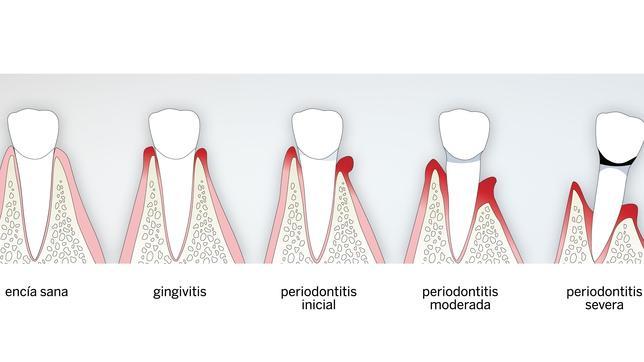 ¿Cuáles son las enfermedades del periodonto?