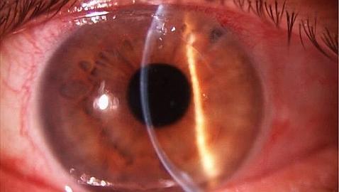 Fumar se relaciona con la pérdida de visión que causa la degeneración macular