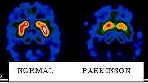 Diferencias entre un cerebro sano y otro con párkinson