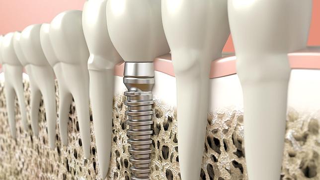 No te olvides de tus implantes dentales; también deben cuidarse