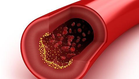 El colesterol obstruye las arterias