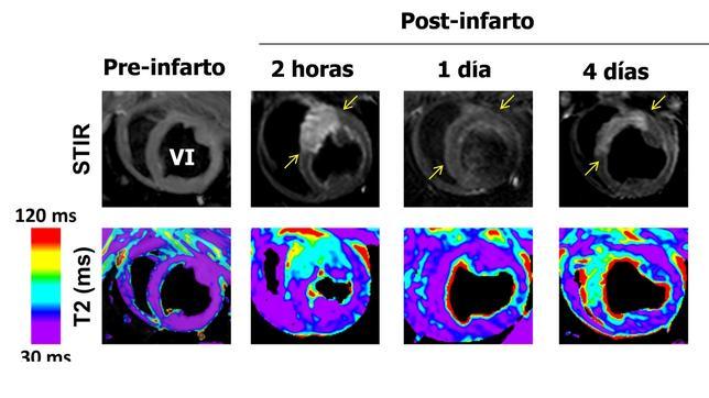 La doble respuesta del corazón tras un infarto sugiere una revisión de las terapias