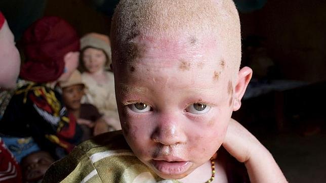 Tanzania prohíbe las actividades de los curanderos para poner fin a los ataques contra los albinos