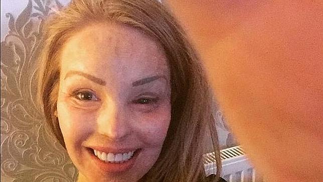 Katie Piper, la modelo a la que su novio desfiguró con ácido: «Las cicatrices no me molestan»