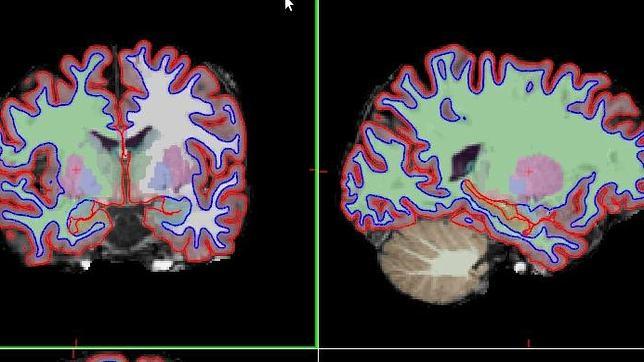 Descubren variaciones genéticas asociadas a cambios en varias estructuras del cerebro