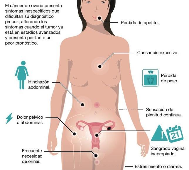 Descubren el papel de dos genes en el cáncer de ovario más agresivo