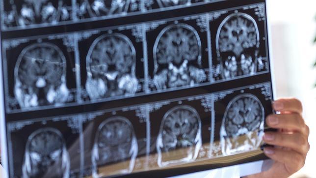 La N-acetil cisteína tiene efectos antiinflatorios