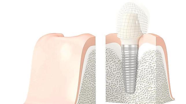 La naturalidad, el último reto de los implantes dentales