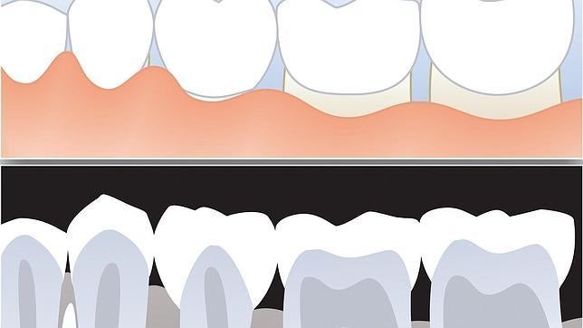 ¿Se puede recuperar el hueso perdido por la enfermedad periodontal?