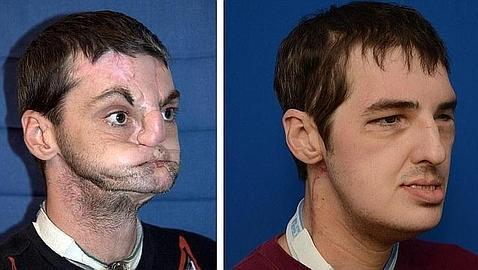 Richard Lee Norris, antes y después del trasplante de cara
