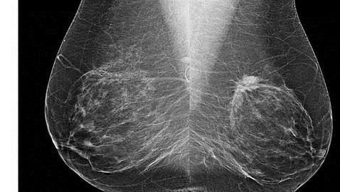 Mamografía digital de un cáncer de mama