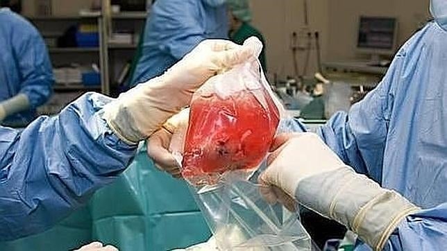 Primer trasplante renal por laparoscopia, a través de la vagina y con la ayuda de un robot