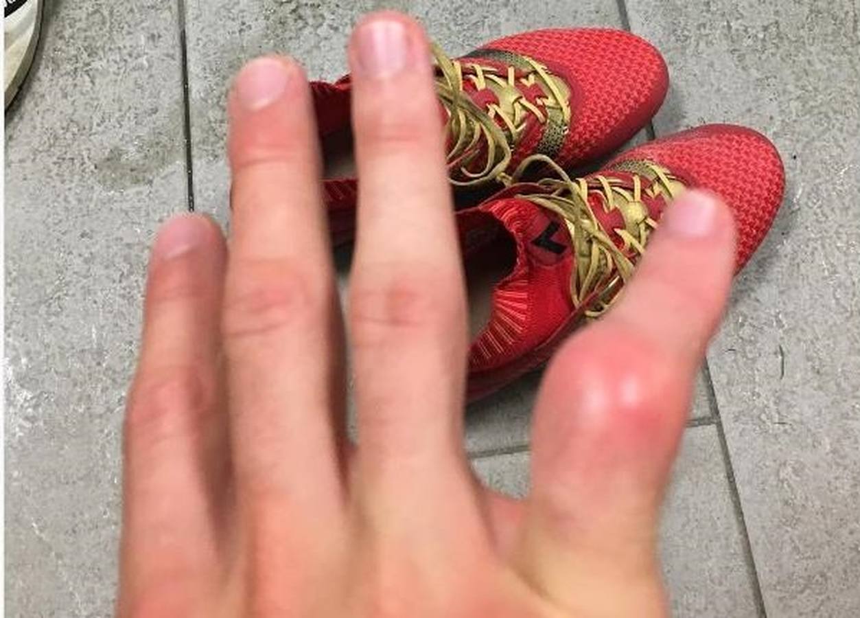 El dedo fracturado de Kieszek. El portero polaco jugó ocho meses con el dedo roto y fue operado al final de temporada