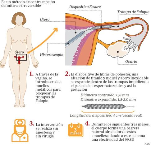 Facilidades para poner fin a la pesadilla del anticonceptivo Essure en Andalucía