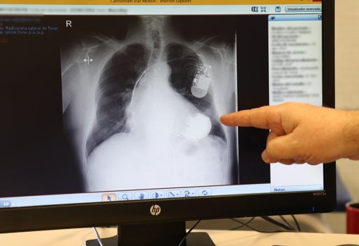Radiografía de Eduardo Rodríguez, donde se observa su implante intracardiaco, gracias al cual puede vivir
