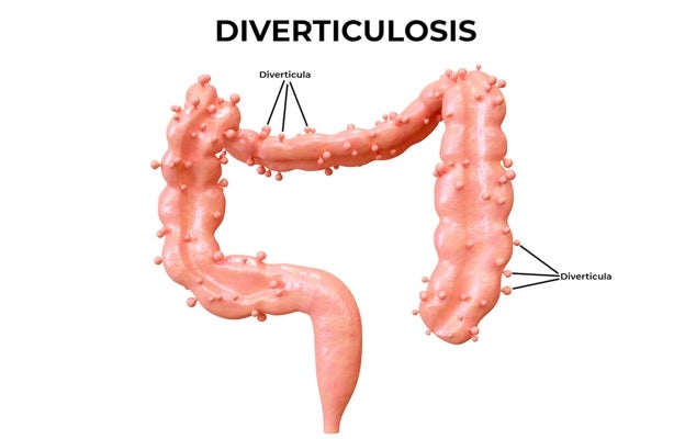 Así se visualiza la diverticulosis.