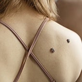 Qué debes hacer para conocer el estado de tus lunares: así es la regla ABCDE