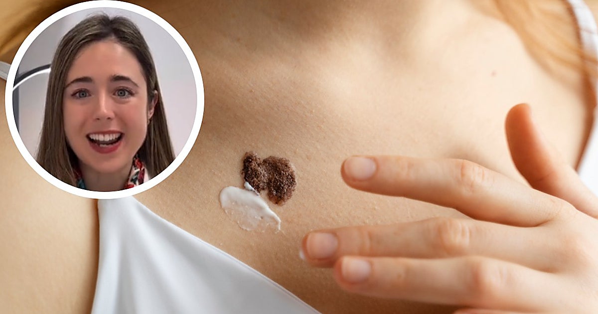 Leire Barrutia, dermatóloga, señala el error más peligroso al cuidar la piel en primavera: «Aumenta muchísimo el riesgo de melanoma»