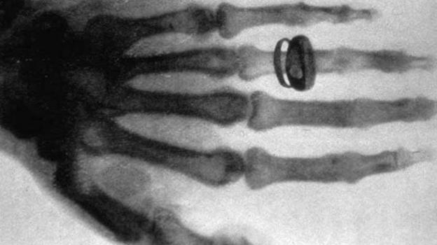 First X-ray of history made by Wilhelm Conrad Röntgen, in which you can see his wife's hand and a ring (1895)