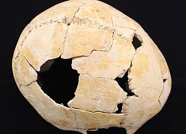 Imagen de herida craneal ocurrida durante la batalla