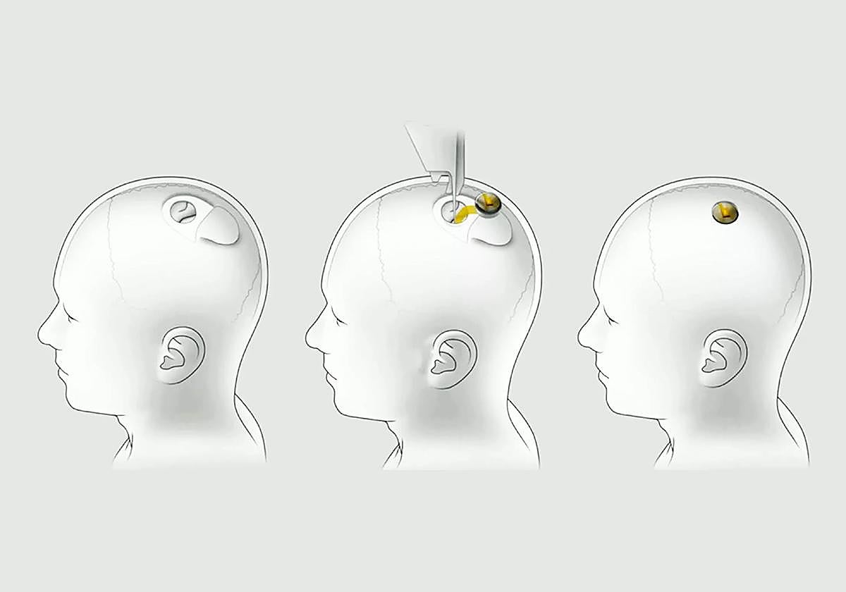 El chip cerebral de Elon Musk