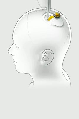 El chip cerebral de Elon Musk
