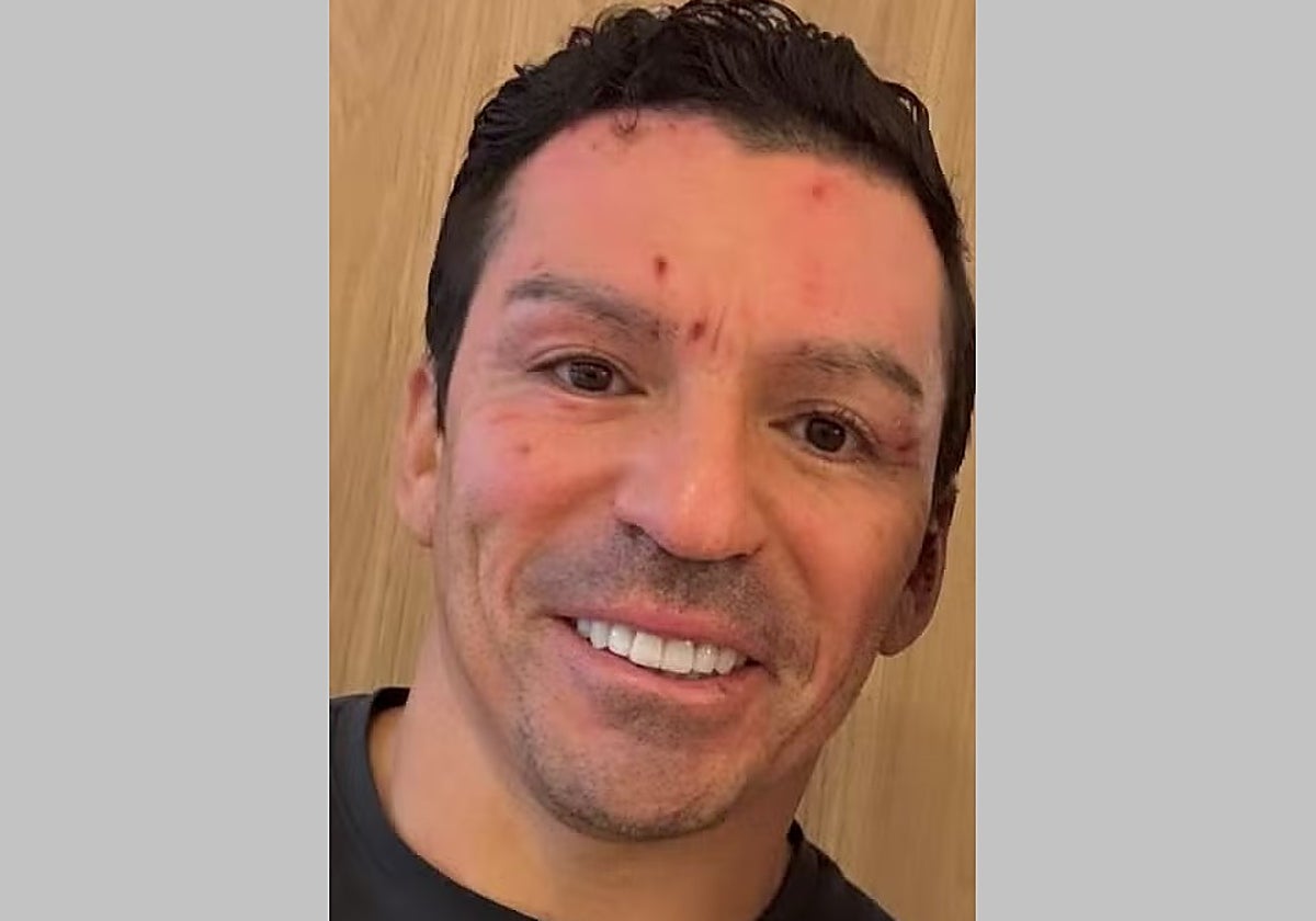 Así quedó la cara de Lúcio tras las quemaduras sufridas por la explosión de una chimenea en su casa