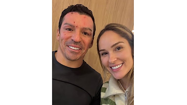 Así quedó la cara de Lúcio tras las quemaduras sufridas por la explosión de una chimenea en su casa