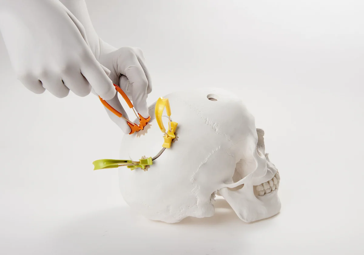 El sistema desarrollado por Neos Surgery: una abrazadera que permite al cirujano fijar un colgajo óseo estándar para cerrar el cráneo tras una neurocirugía