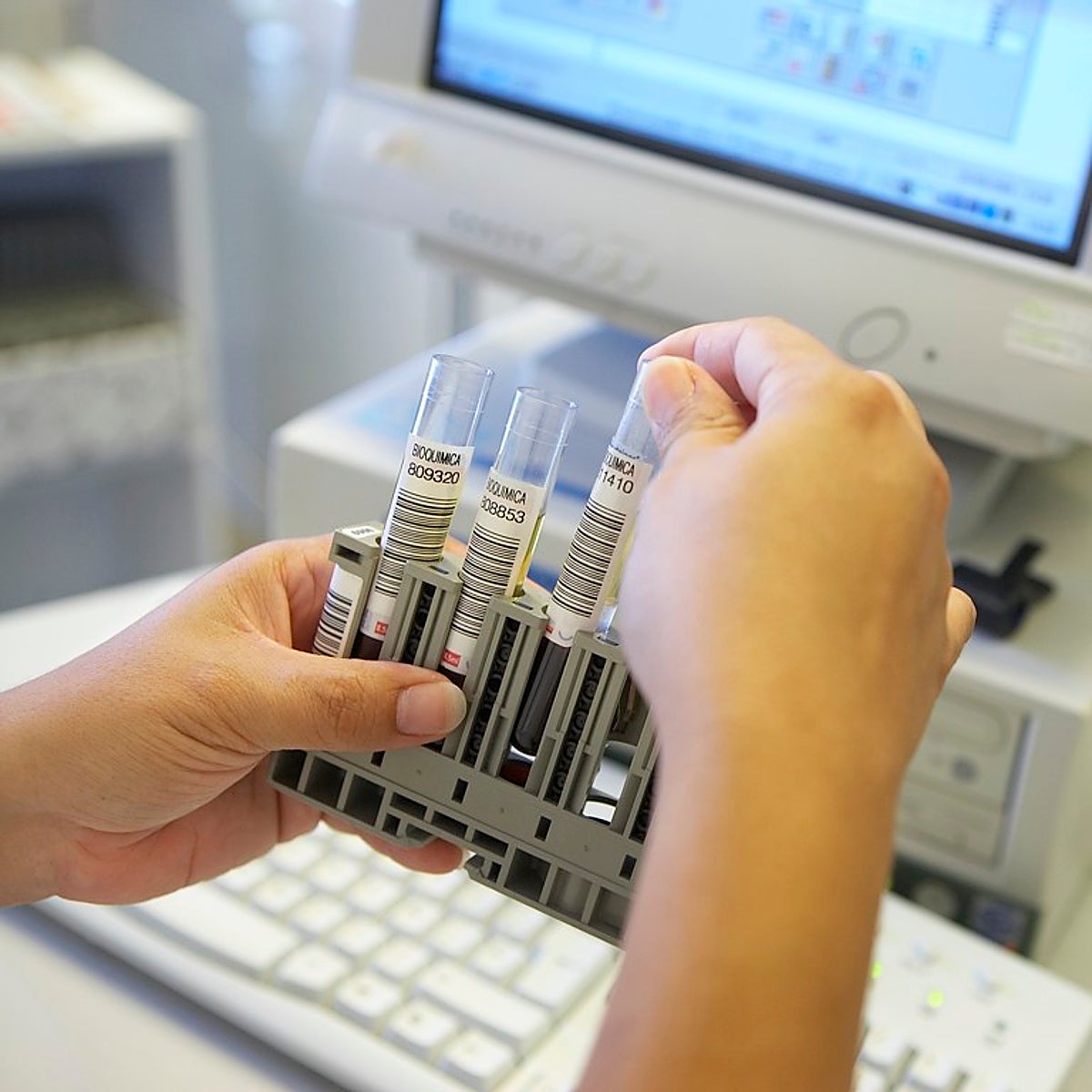 Canarias alcanza los 78 casos de viruela del mono